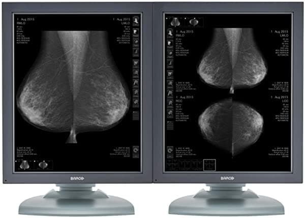 Barco Nio Mdng-5121 - Monitores De Diagnóstico De Mammografía Digital A Escala De Grises (5 Mp 2 Unidades)